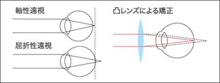 遠視の図解