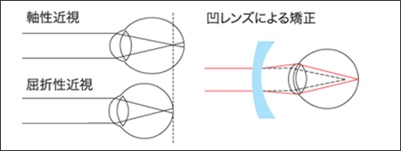 近視の図解